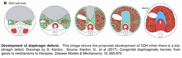 CDH review: from genes to mechanisms to therapies